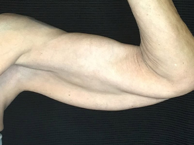Patient #57342: Brachioplasty Before Image