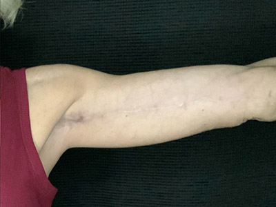 Patient #57342: Brachioplasty After Image