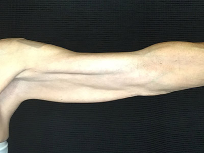 Patient #57342: Brachioplasty Before Image