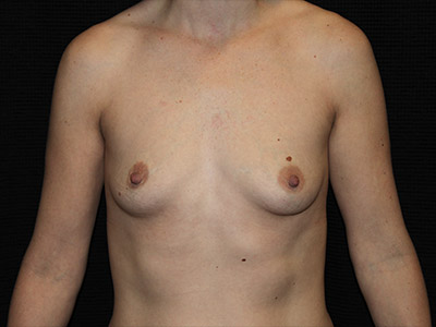 Patient #20328: Breast Augmentation Before Image