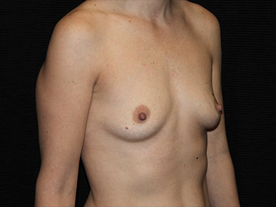 Patient #20328: Breast Augmentation Before Image