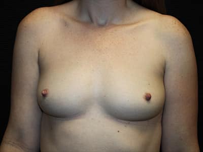 Patient #43476: Breast Augmentation Before Image