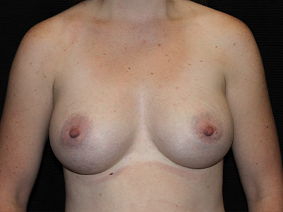 Patient #68127: Breast Augmentation After Image