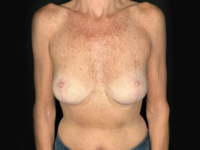 Patient #99995: Breast Implant Removal, Breast Lift, & Capsulectomy After Image