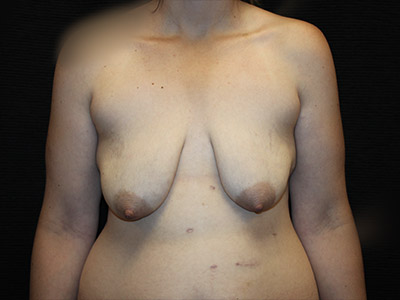Patient #03762: Breast Augmentation & Breast Lift Before Image