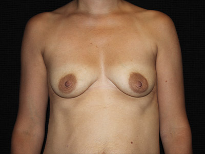 Patient #56440: Breast Augmentation & Breast Lift Before Image
