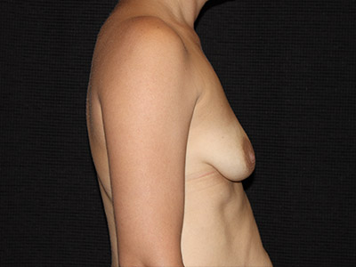 Patient #56440: Breast Augmentation & Breast Lift Before Image