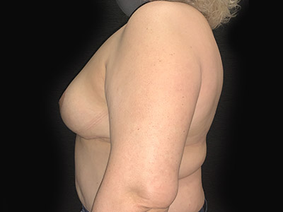 Patient #29178: Breast Implant Removal, Breast Lift & Capsulectomy After Image