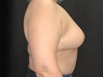 Patient #29178: Breast Implant Removal, Breast Lift & Capsulectomy After Image