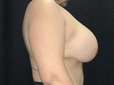 Patient #29178: Breast Implant Removal, Breast Lift & Capsulectomy Before Image