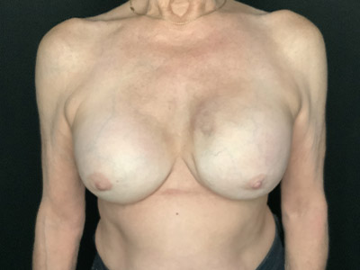 Patient #89430: Breast Implant Exchange, Capsulectomy, & Acellular Dermal Matrix After Image