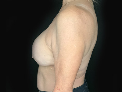 Patient #89430: Breast Implant Exchange, Capsulectomy, & Acellular Dermal Matrix After Image