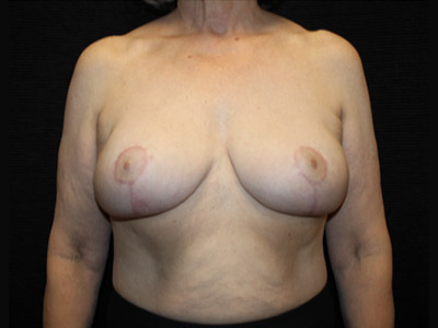Patient #34158: Breast Implant Removal & Breast Lift After Image