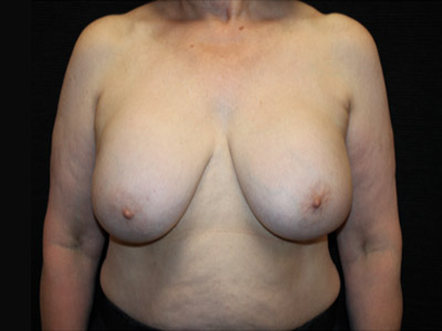 Patient #34158: Breast Implant Removal & Breast Lift Before Image