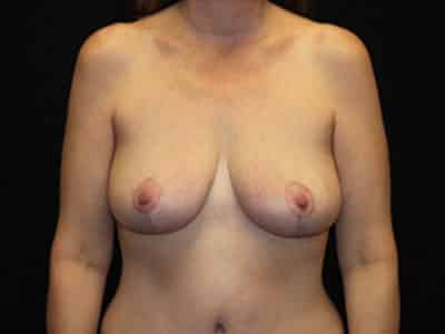 Patient #48432: Breast Reduction After Image