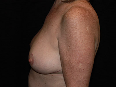 Patient #56962: Breast Reduction After Image