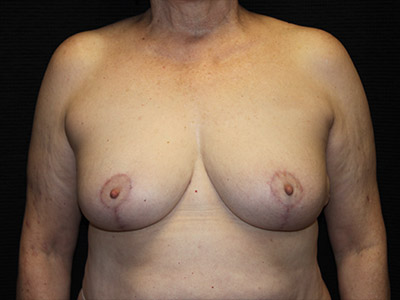 Patient #68731: Breast Reduction After Image