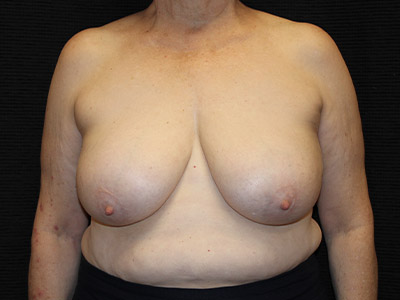 Patient #68731: Breast Reduction Before Image