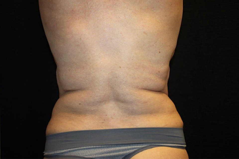 Patient #08888: CoolSculpting After Image