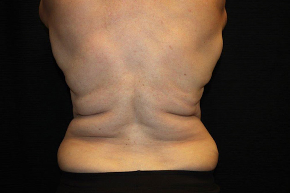 Patient #08888: CoolSculpting Before Image