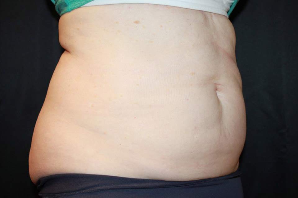 Patient #13800: CoolSculpting After Image