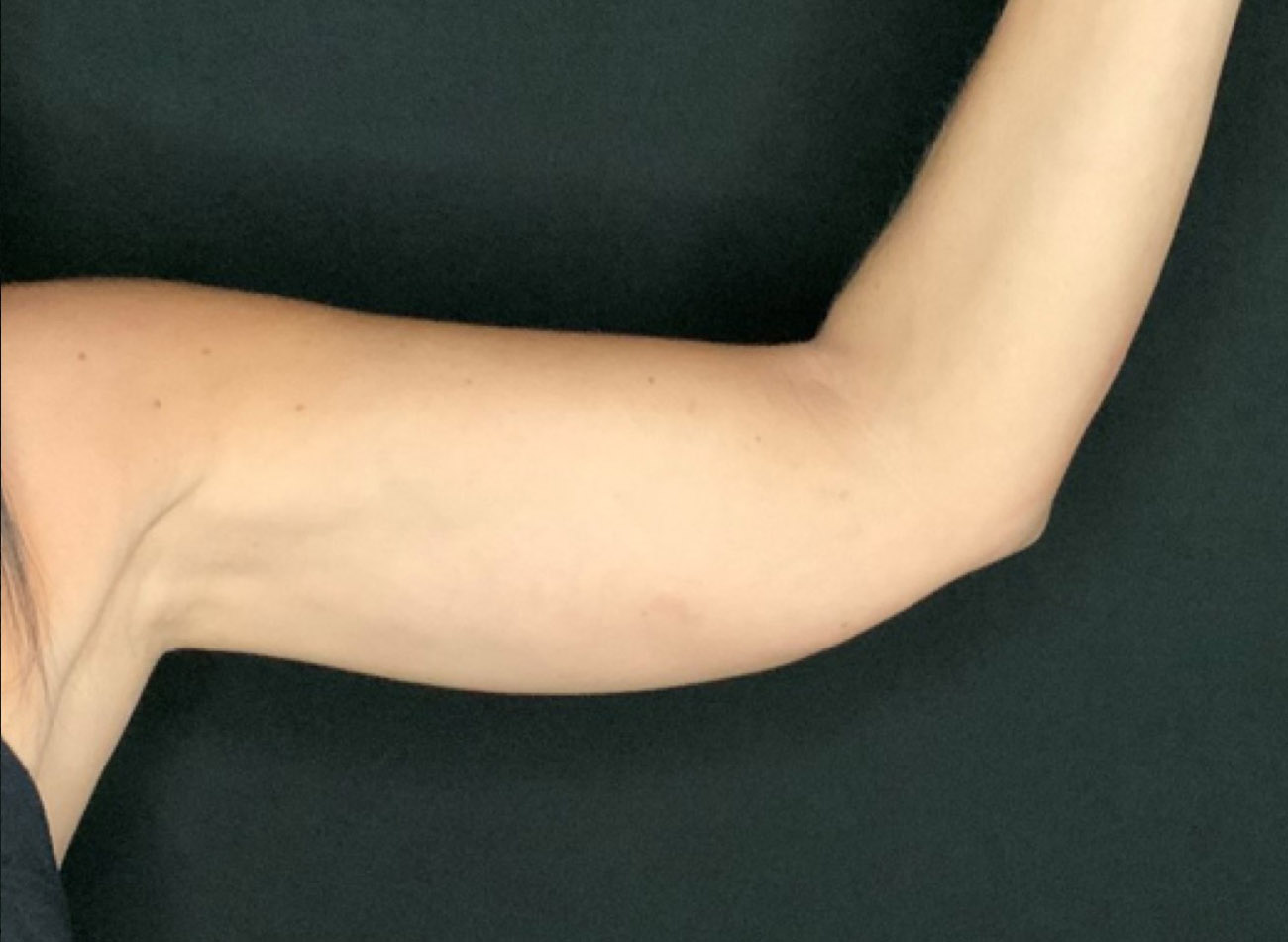 Patient #64168: CoolSculpting After Image