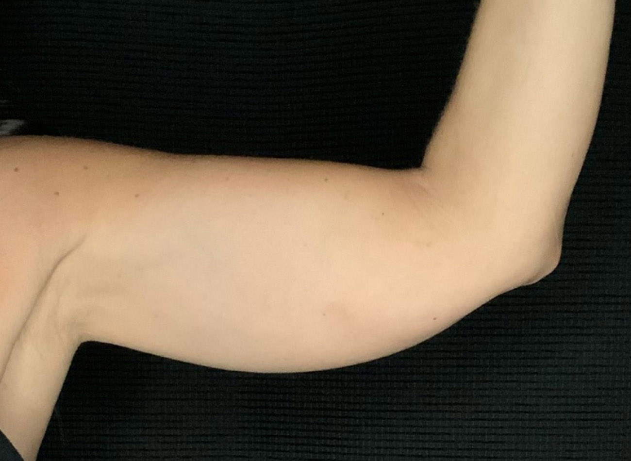 Patient #64168: CoolSculpting Before Image