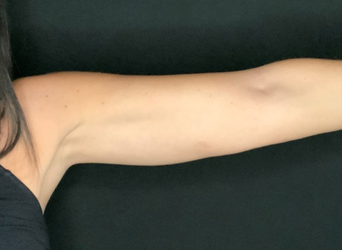 Patient #64168: CoolSculpting After Image