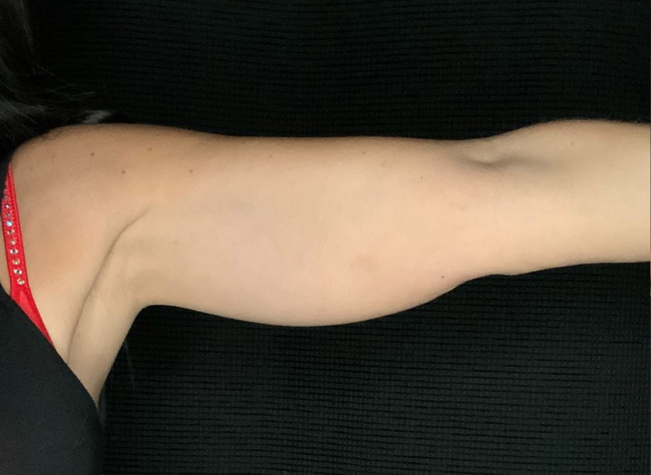 Patient #64168: CoolSculpting Before Image