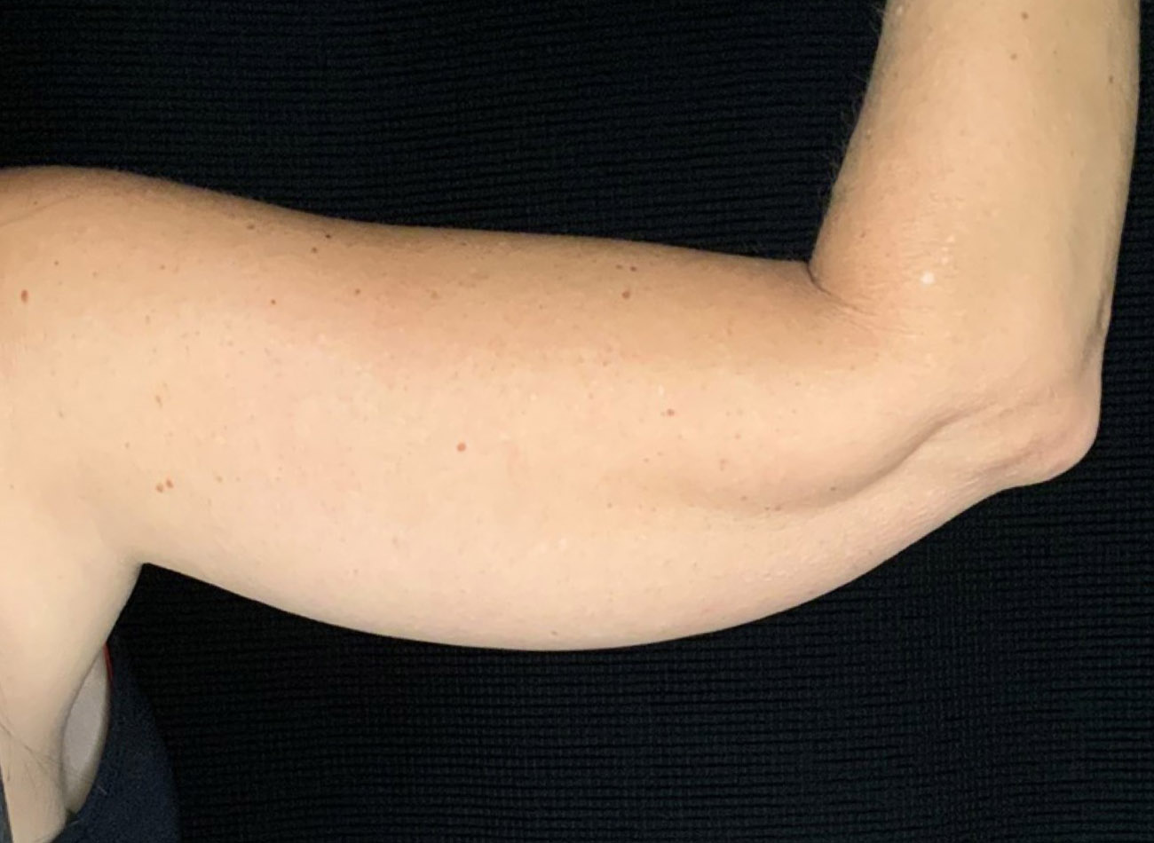 Patient #64168: CoolSculpting Before Image