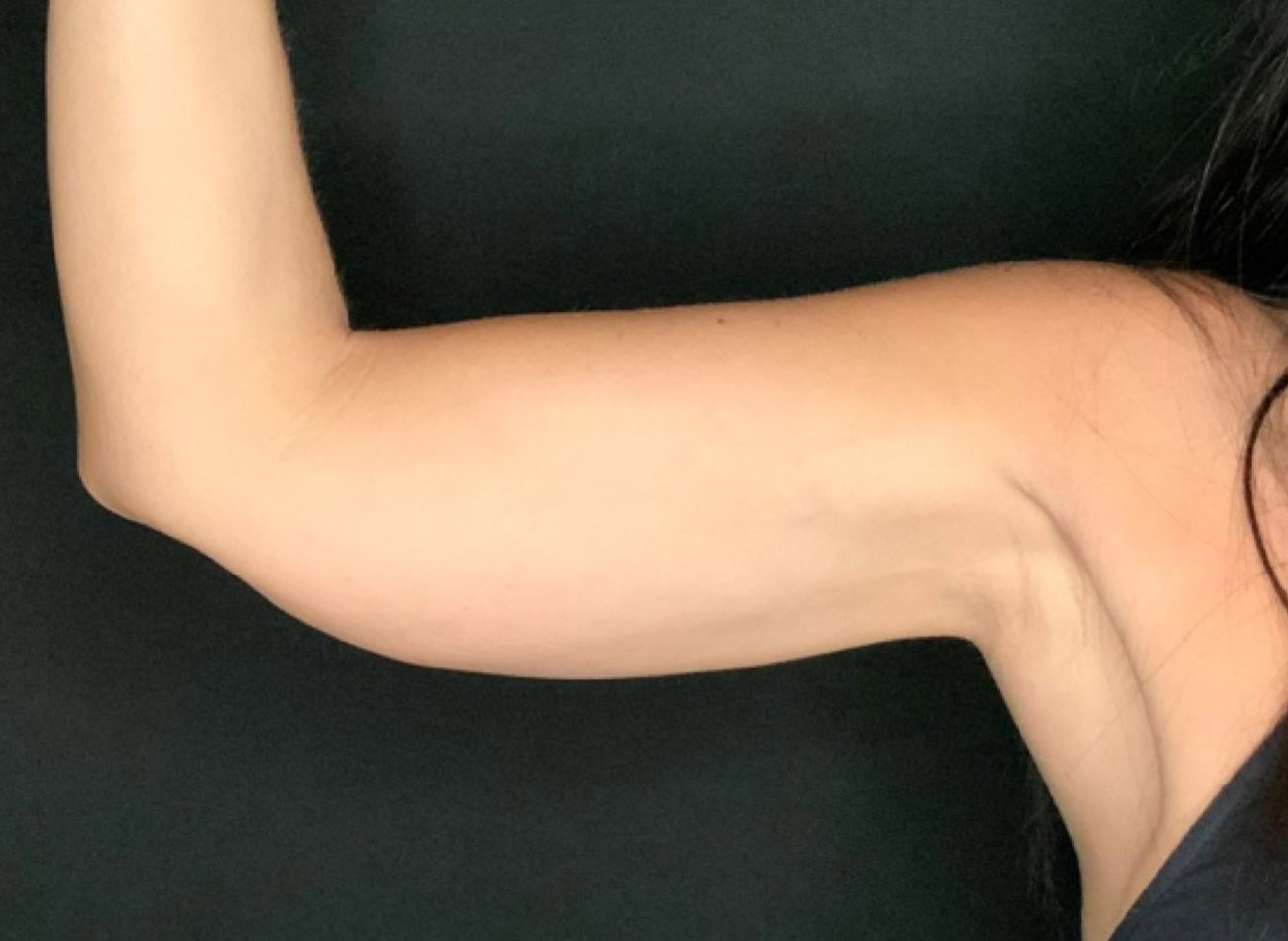 Patient #64168: CoolSculpting After Image