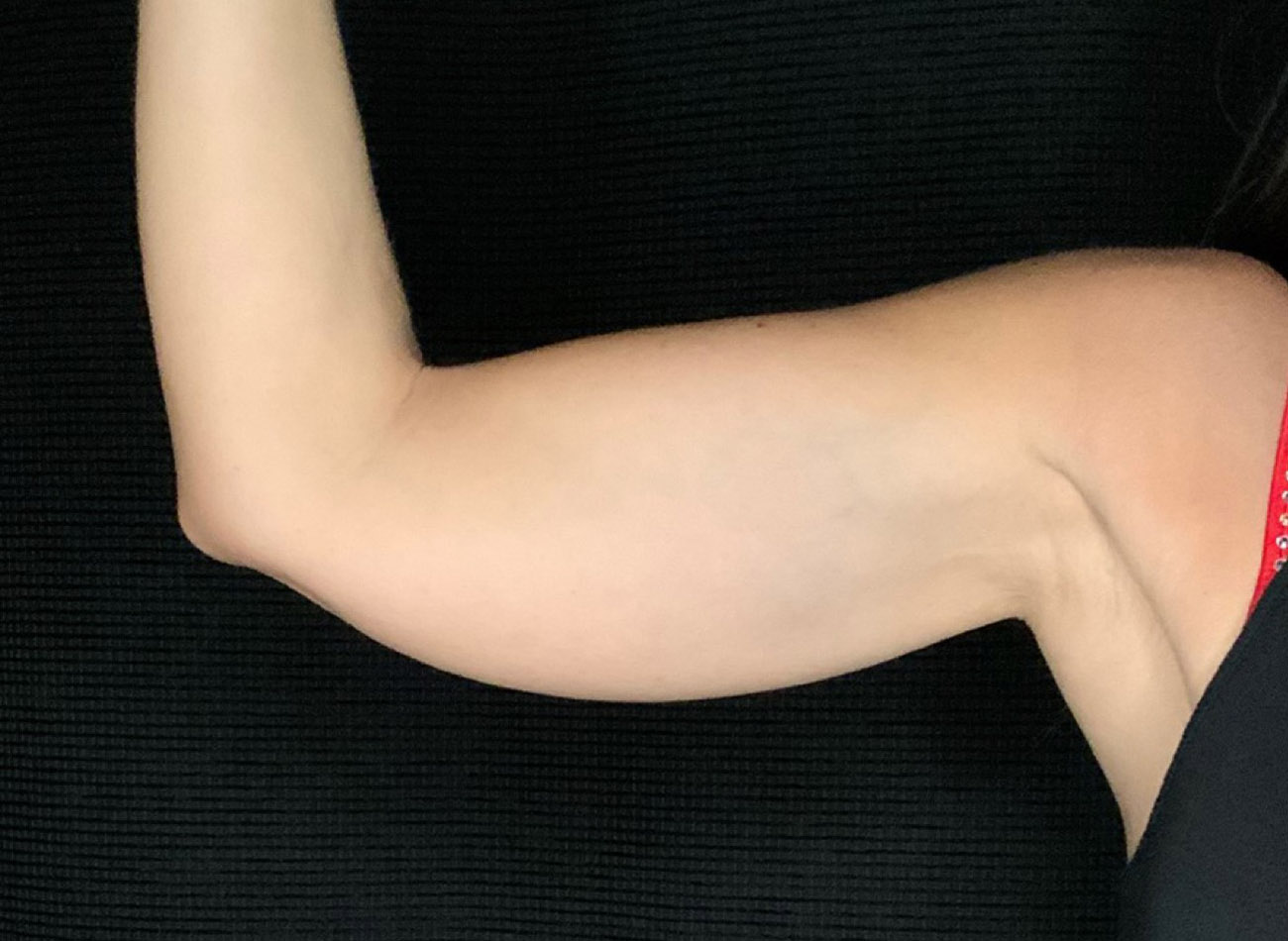 Patient #64168: CoolSculpting Before Image