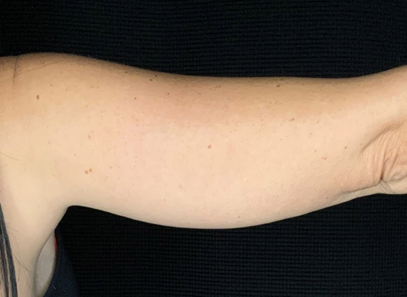 Patient #64168: CoolSculpting Before Image