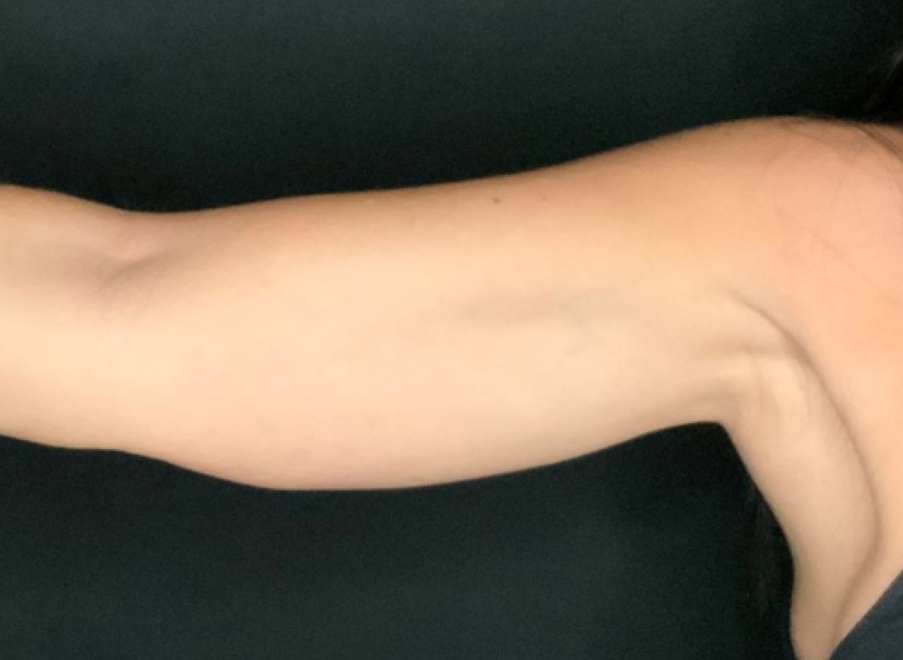 Patient #64168: CoolSculpting After Image