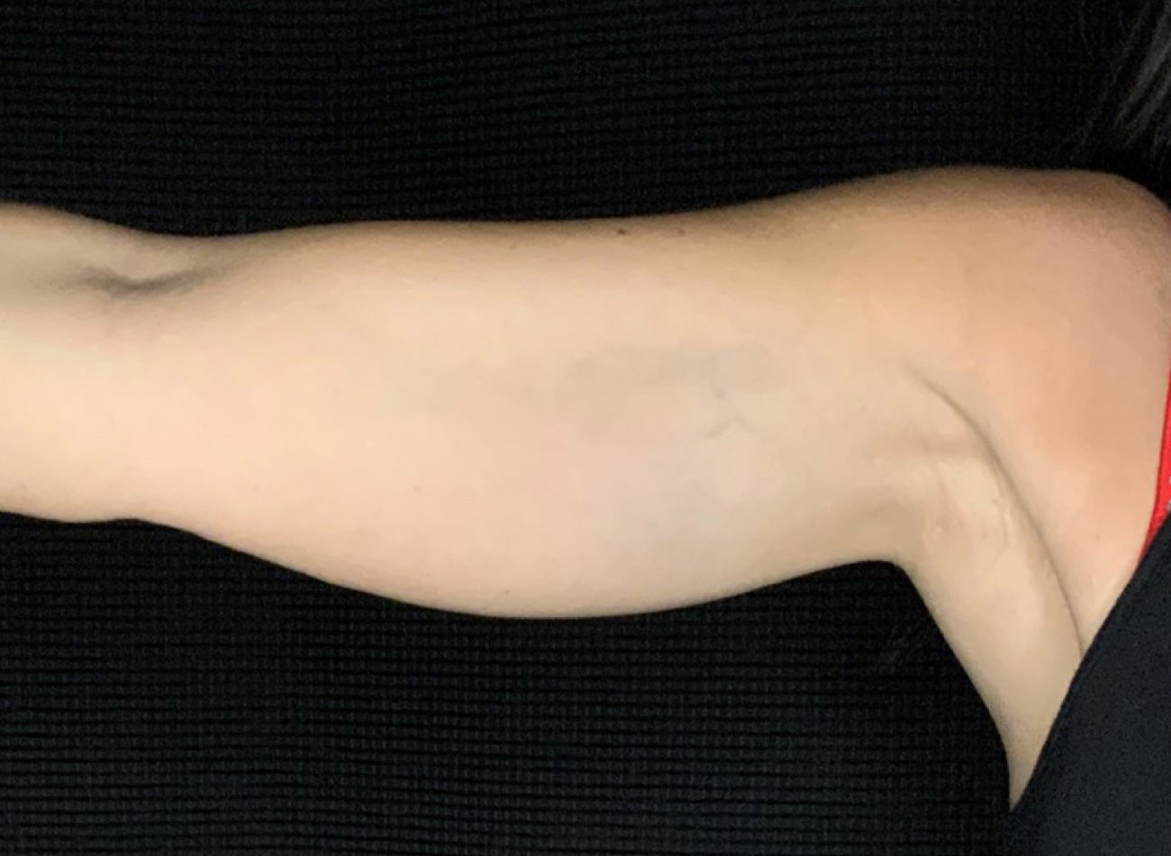 Patient #64168: CoolSculpting Before Image