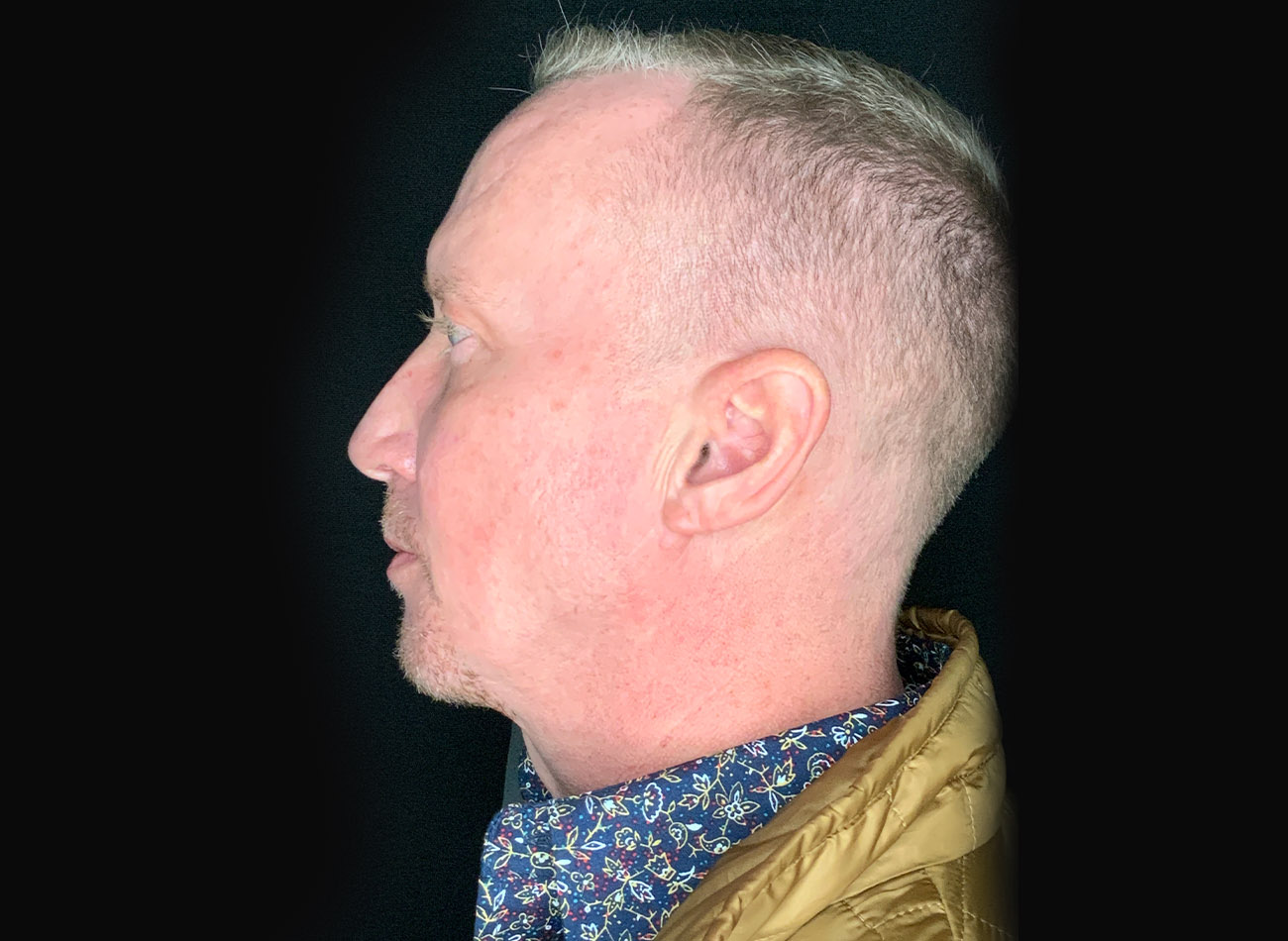 Patient #32637: FaceTite After Image