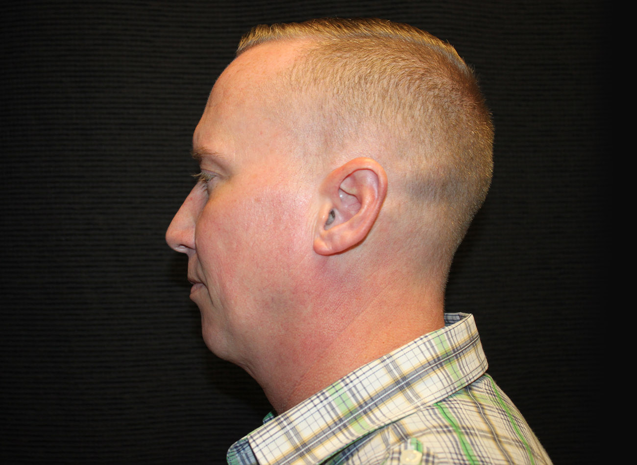 Patient #32637: FaceTite Before Image