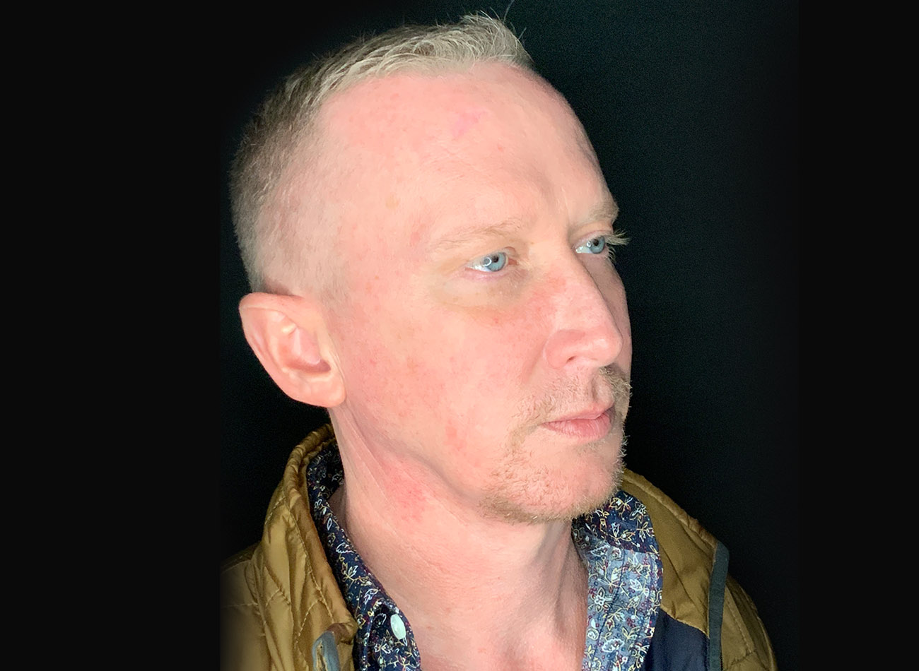 Patient #32637: FaceTite After Image