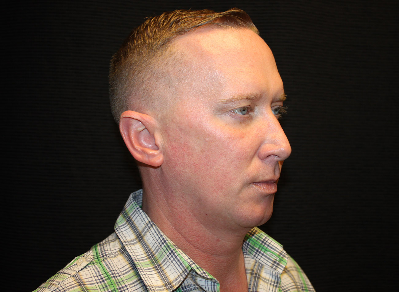 Patient #32637: FaceTite Before Image