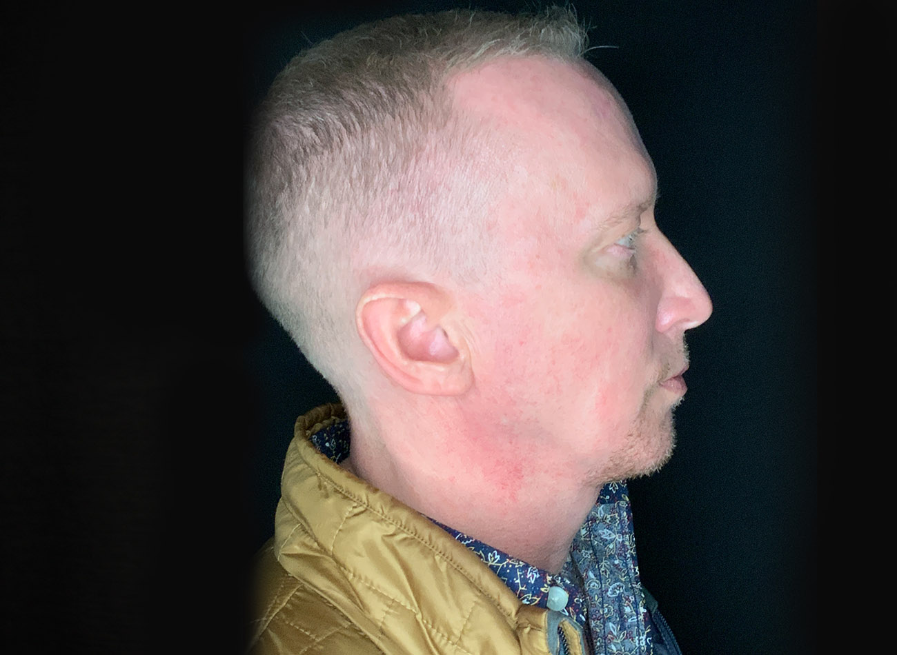 Patient #32637: FaceTite After Image