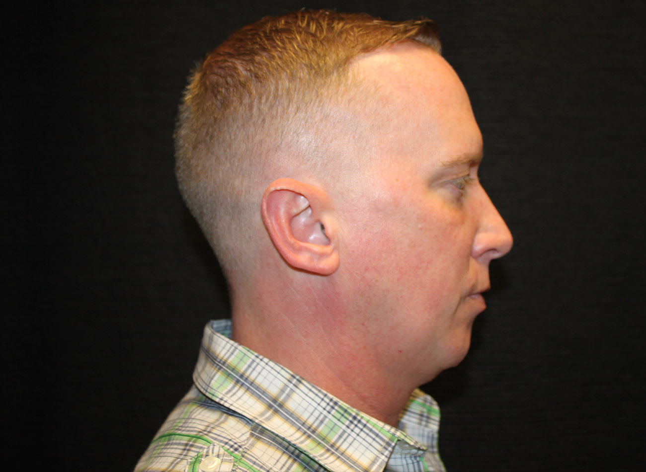 Patient #32637: FaceTite Before Image