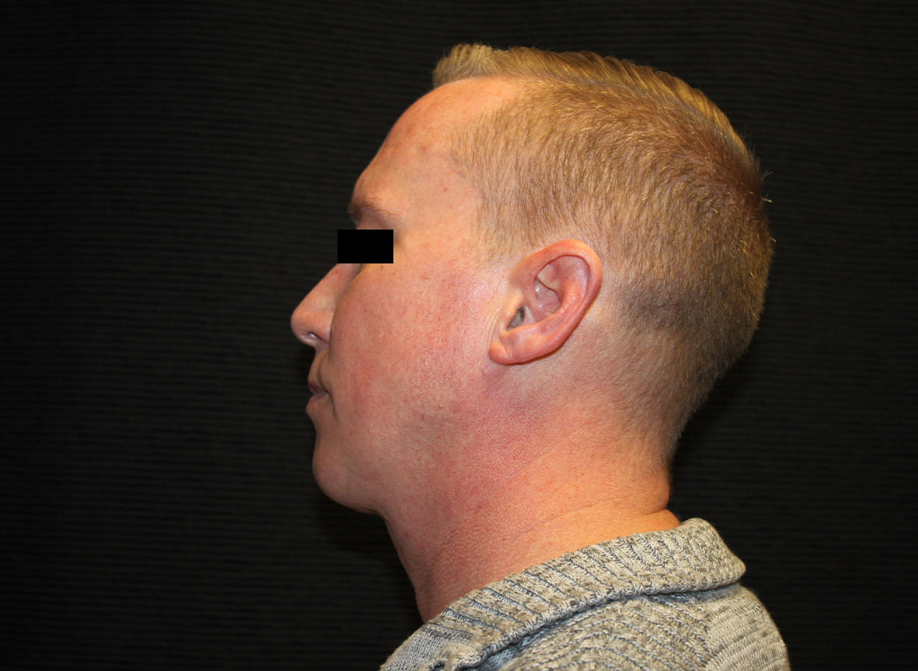 Patient #46455: FaceTite with Liposuction and Morpheus8 After Image