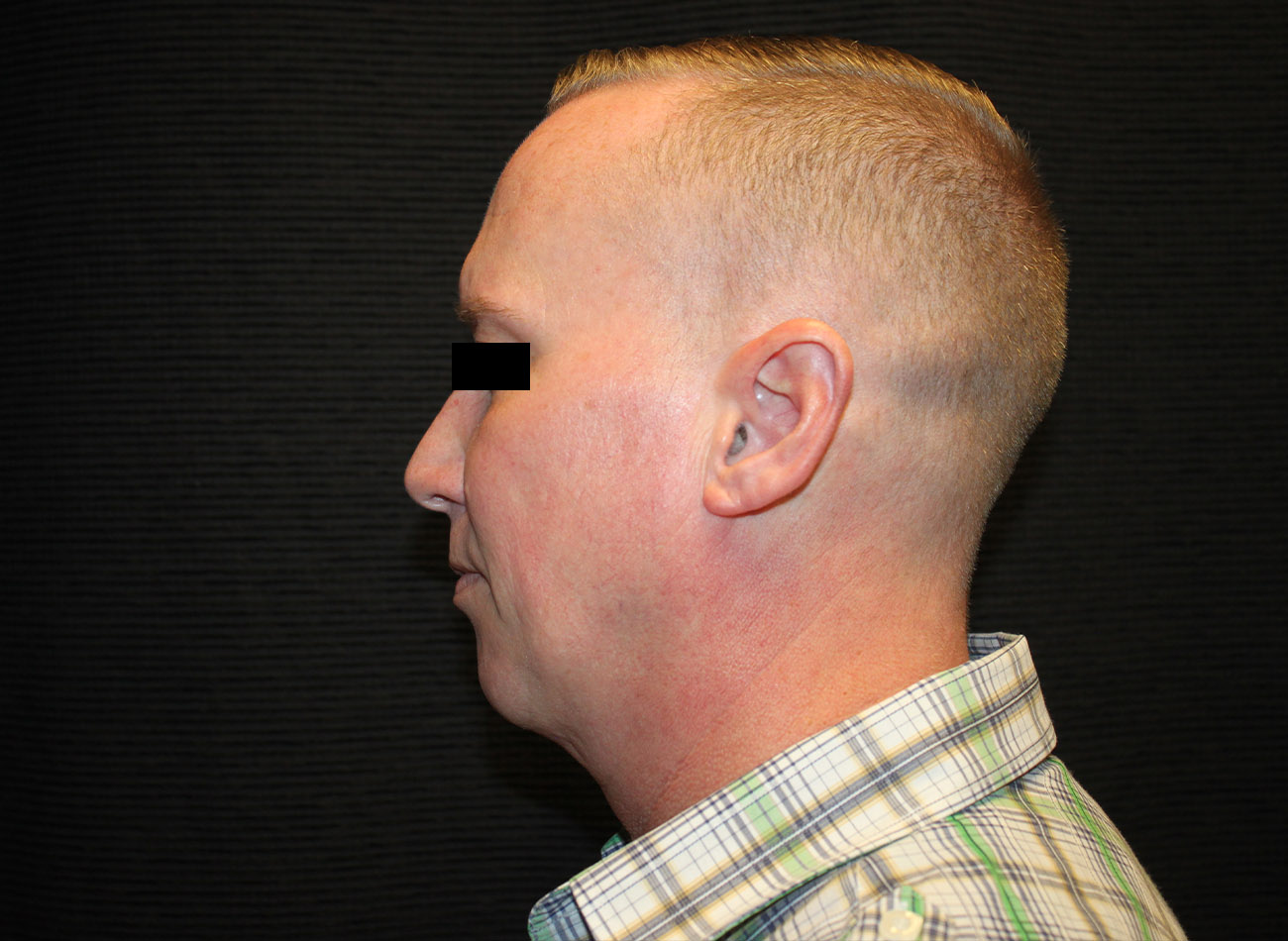 Patient #46455: FaceTite with Liposuction and Morpheus8 Before Image