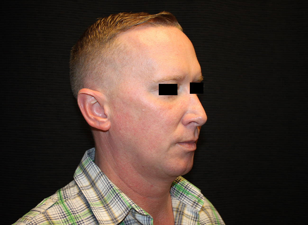 Patient #46455: FaceTite with Liposuction and Morpheus8 Before Image
