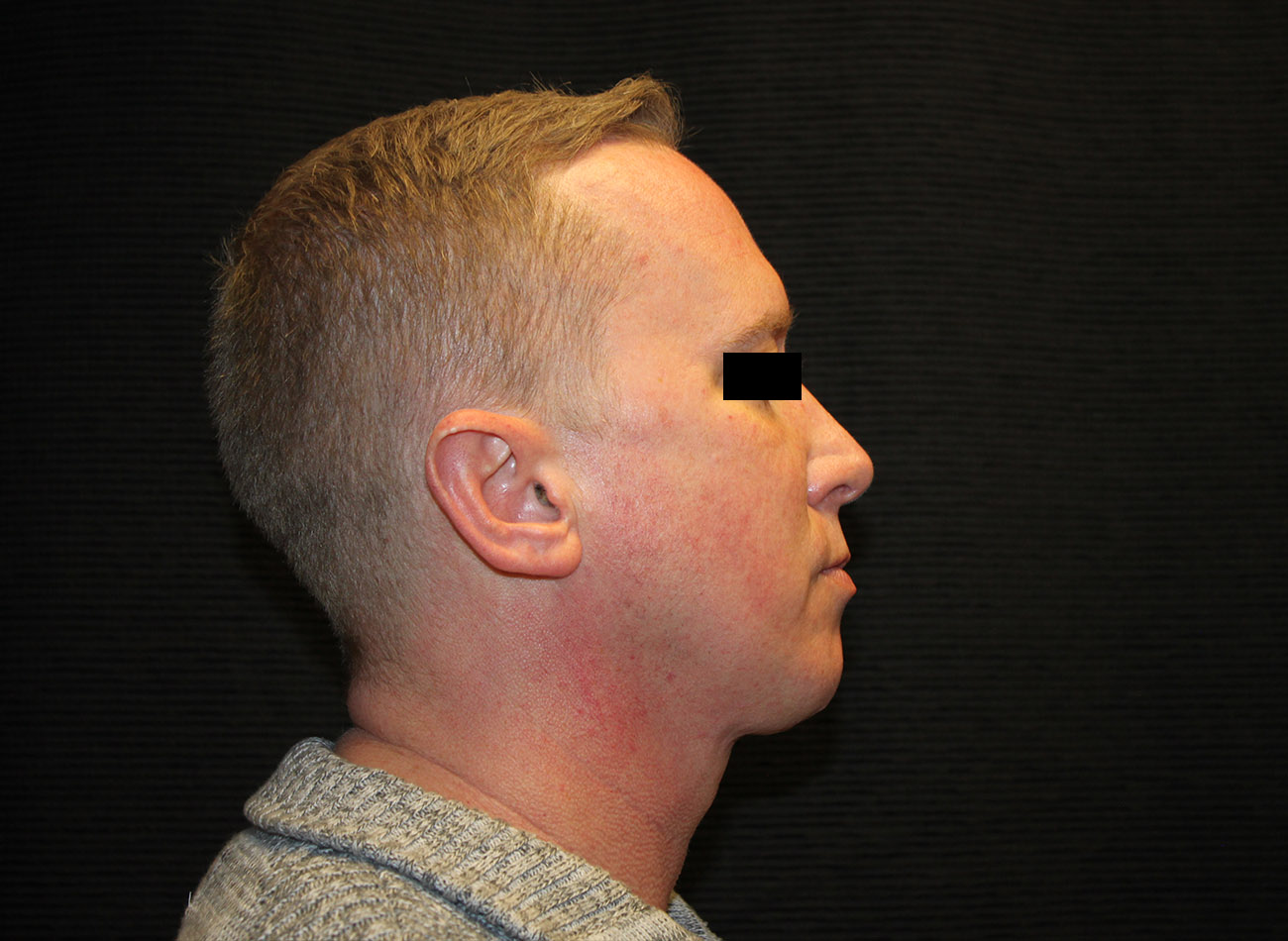 Patient #46455: FaceTite with Liposuction and Morpheus8 After Image