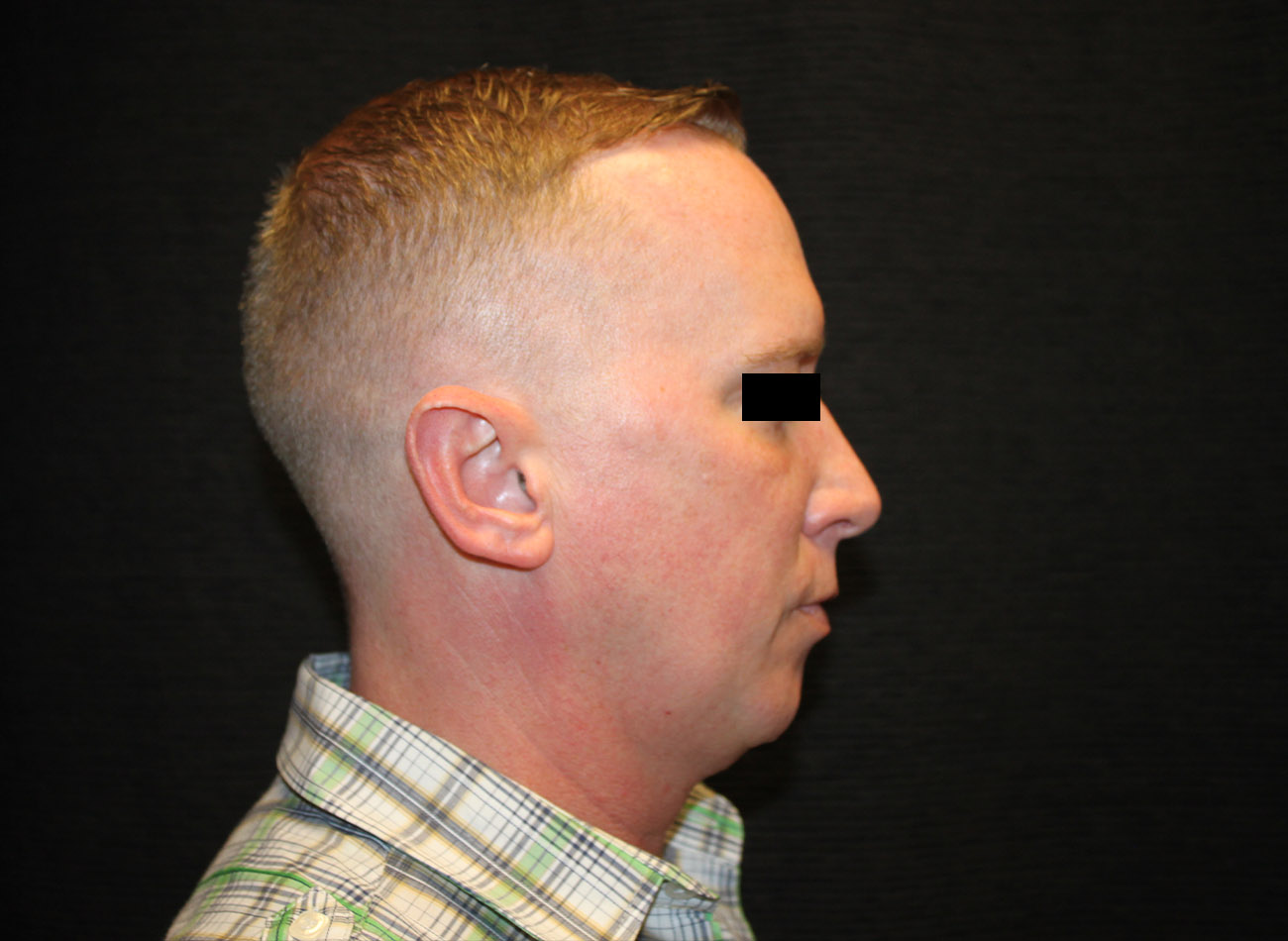 Patient #46455: FaceTite with Liposuction and Morpheus8 Before Image