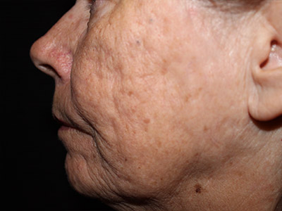 Patient #80299: Fillers for Acne Scarring After Image
