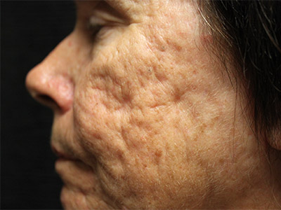 Patient #80299: Fillers for Acne Scarring Before Image