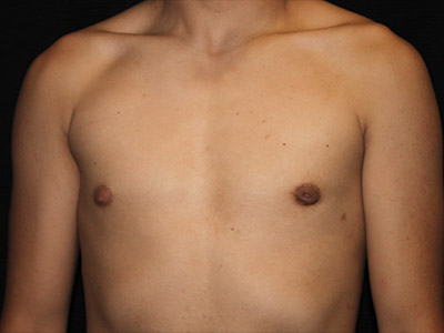 Patient #30815: Gynecomastia with Liposuction After Image
