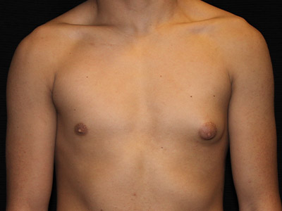 Patient #30815: Gynecomastia with Liposuction Before Image